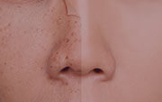Facial Discoloration Treatment