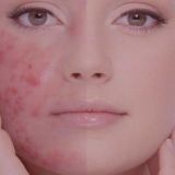 Anti Acne Facial